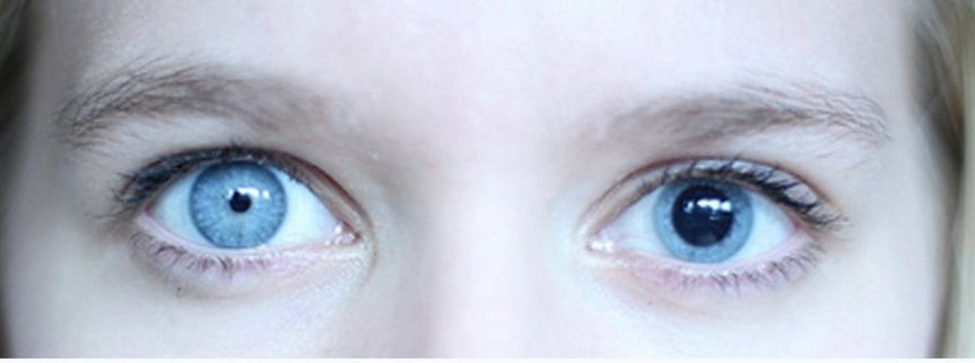 Anizokori neden olur