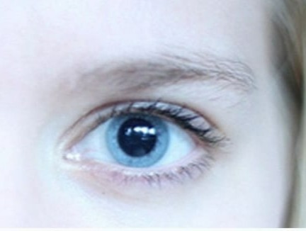 anizokori neden olur