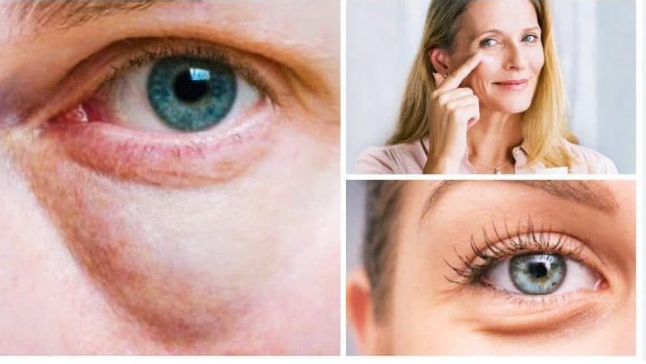 Göz altları neden şişer