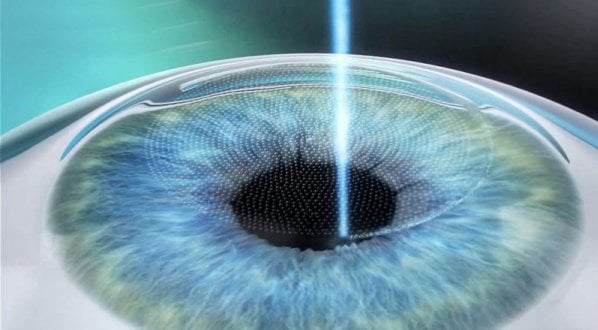 Göz çizdirme ameliyatı fiyat-İdeal Göz